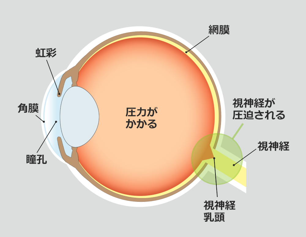 緑内障