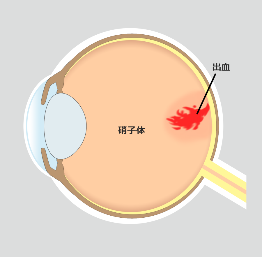 飛蚊症