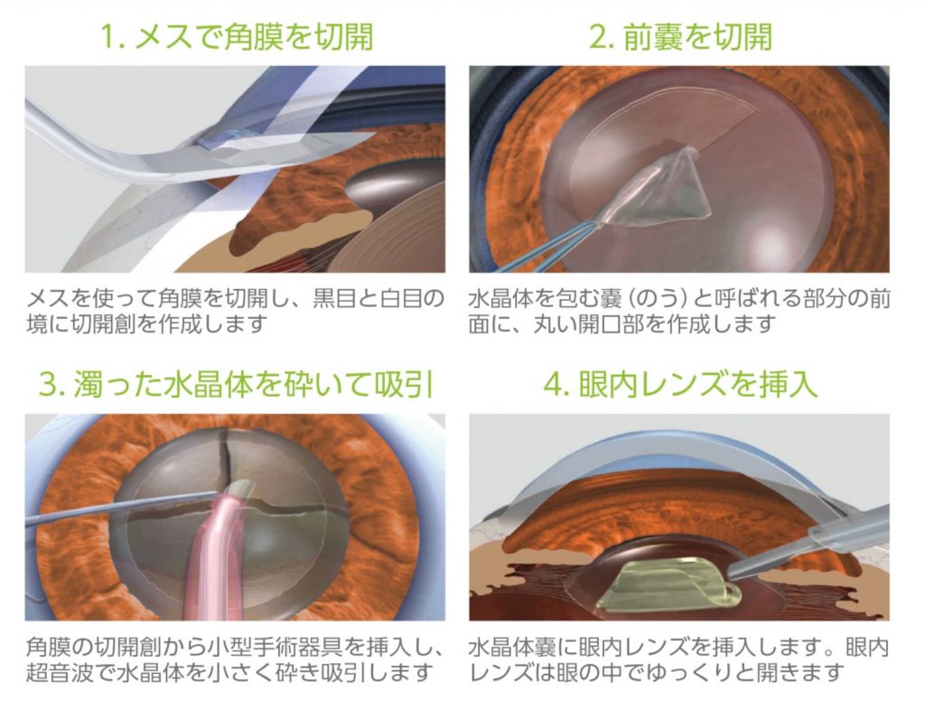 白内障超音波手術