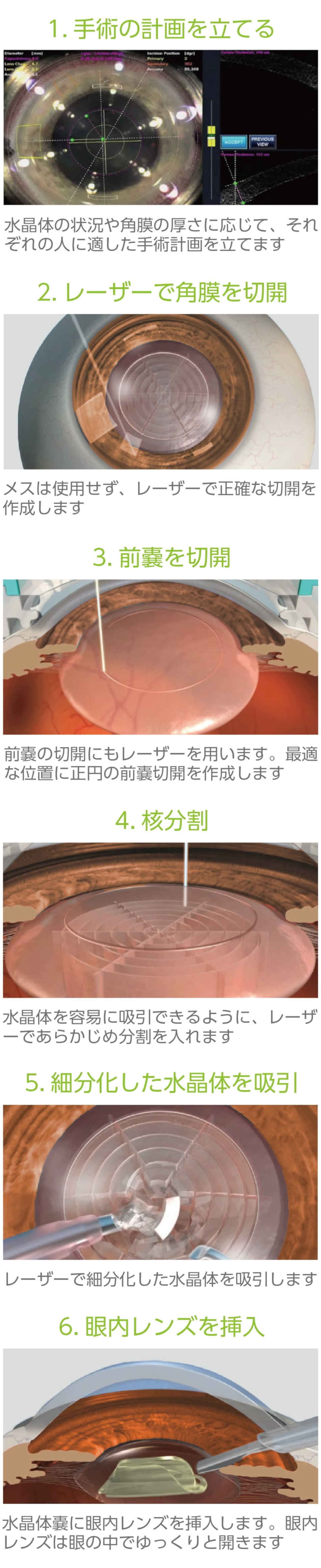 白内障レーザー手術