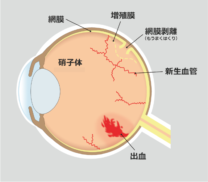 糖尿病網膜症