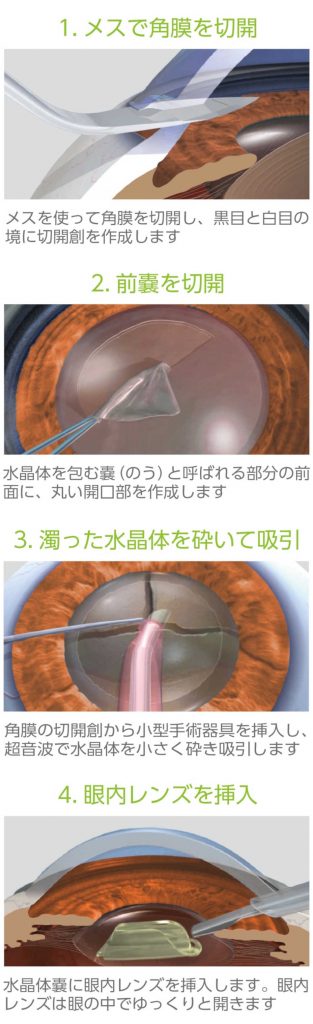 白内障超音波手術