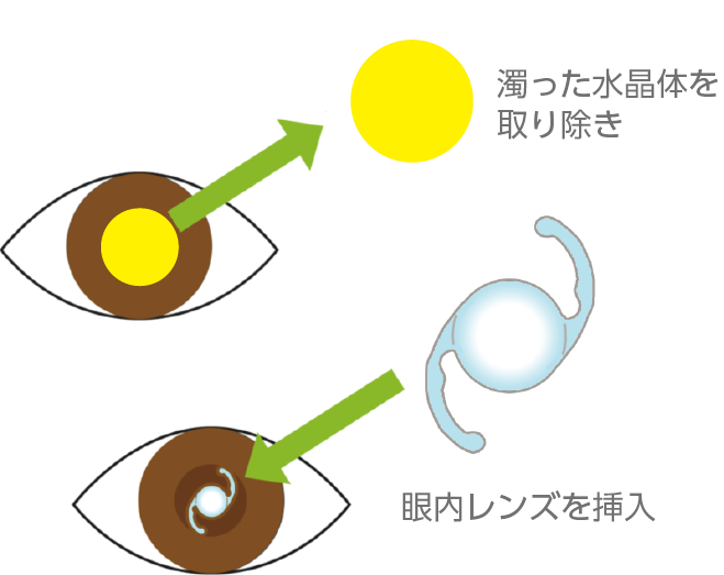 白内障の手術