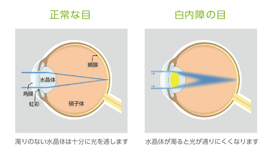 白内障とは