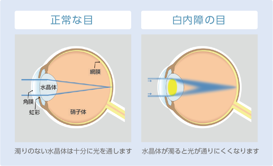 白内障とは