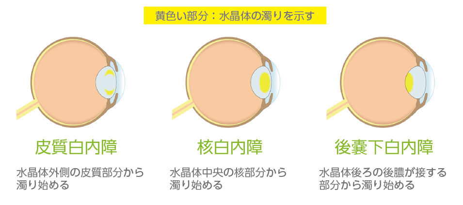 白内障の種類