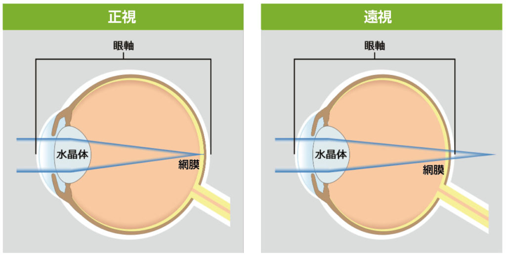 遠視矯正と白内障手術～遠視の仕組みと矯正方法・老眼との関係