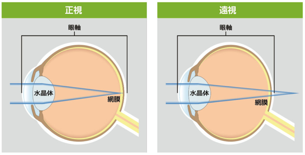 遠視の仕組み